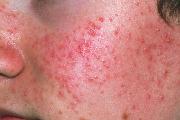 Acne occurs when hair follicles become clogged.