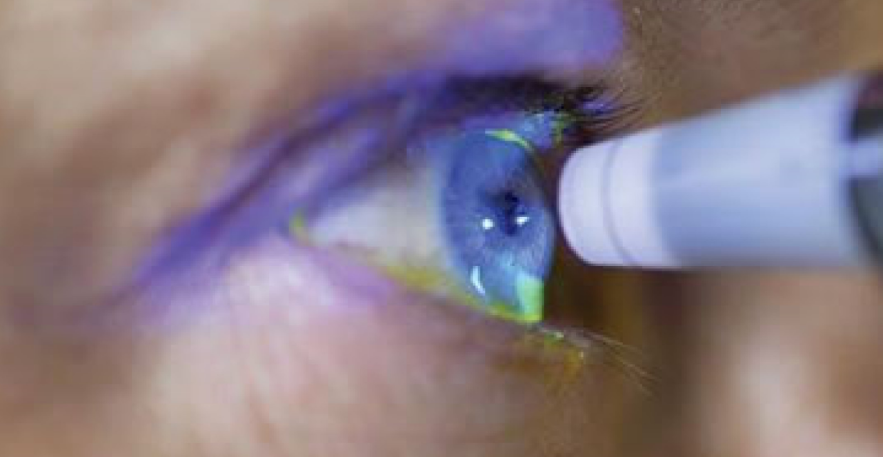 “A ndjeni presion pas syve? Ja çfarë mund të fshehë tensioni i syrit dhe kur duhet të shkoni menjëherë te mjeku!”